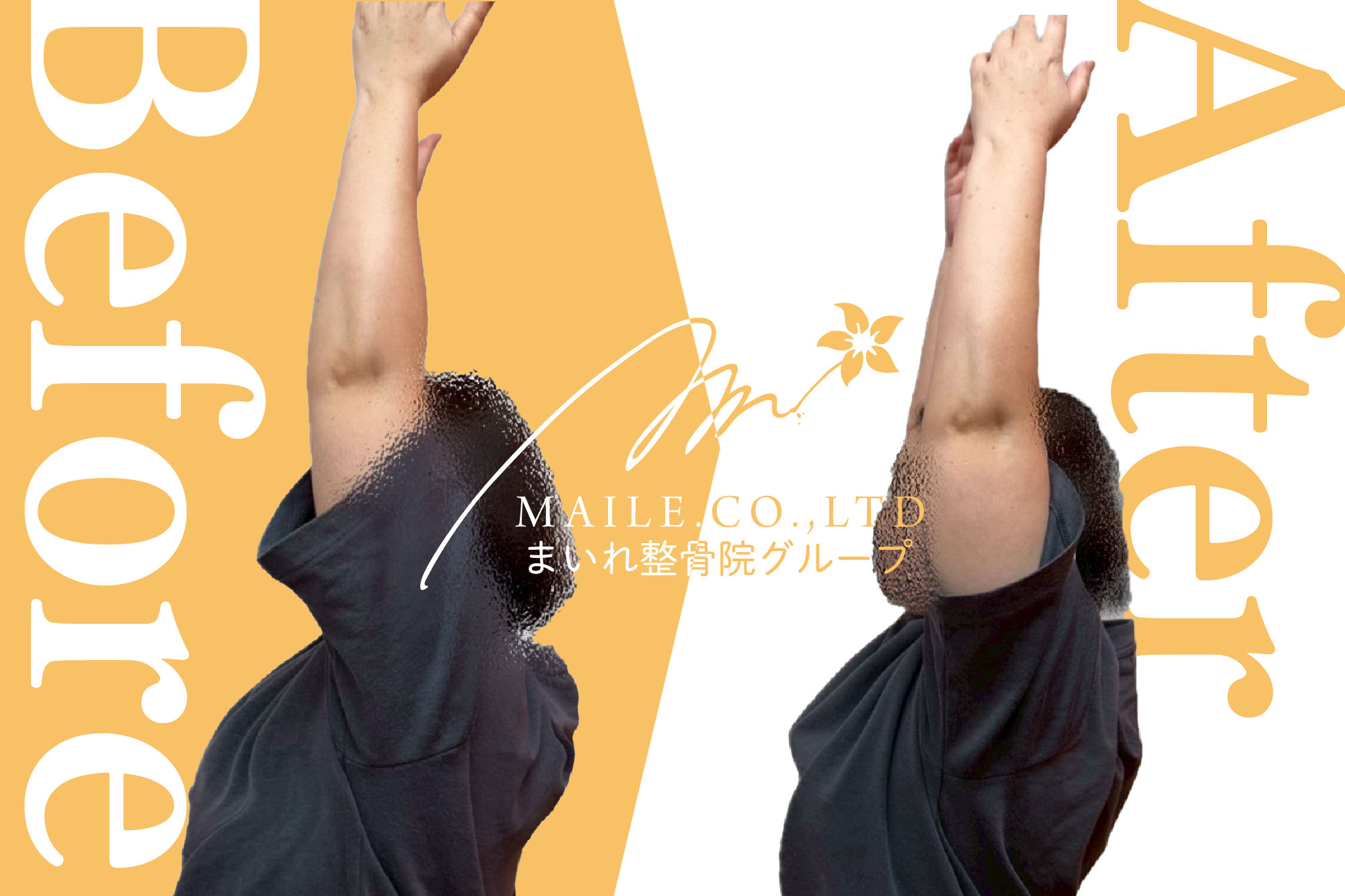 五十肩ビフォーアフター